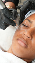 Gesichtsbehandlung - Microneedling (5er Paket)